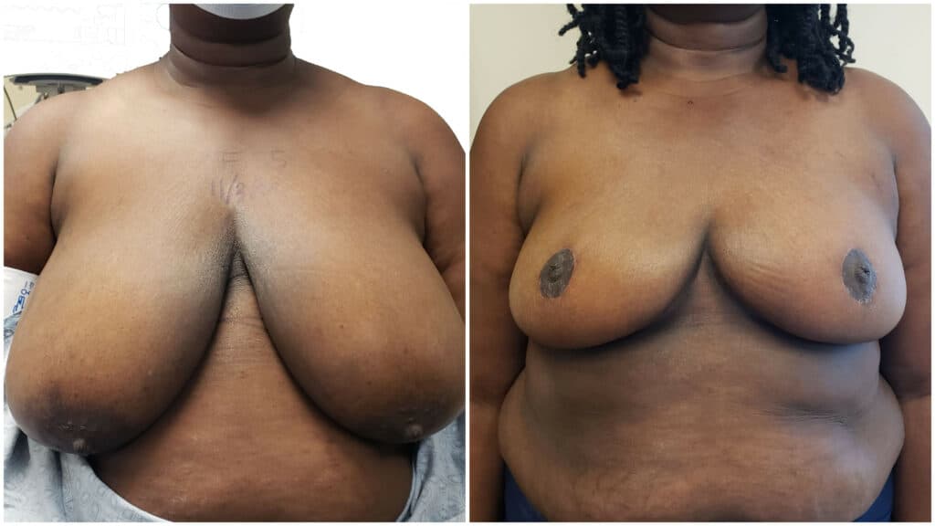 SWIMBreastReconstructionDrLee