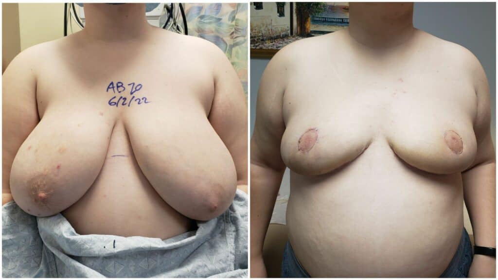 SWIMBreastReconstructionDrLee2