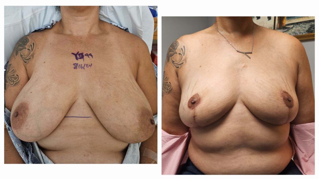 SFLBreast JuneLee