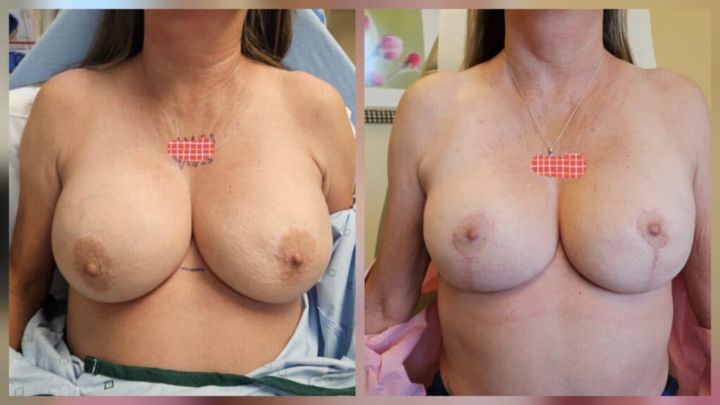 (55 year old woman high risk for breast cancer with breast implants from 1997 who underwent outpatient Goldilocks Mastectomy; 10 months postop)